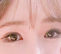 I got ptosis correction @_@