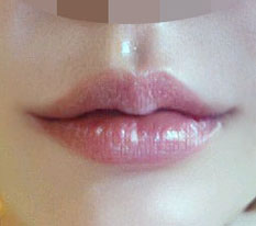 Mọi người hãy phẫu thuật nâng góc miệng chứ đừng tiêm filler nhé