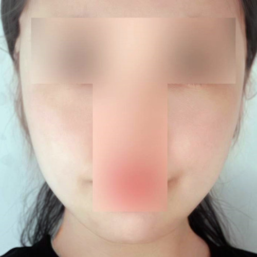 Căng chỉ cho nọng cằm chảy xệ và má chảy xệ