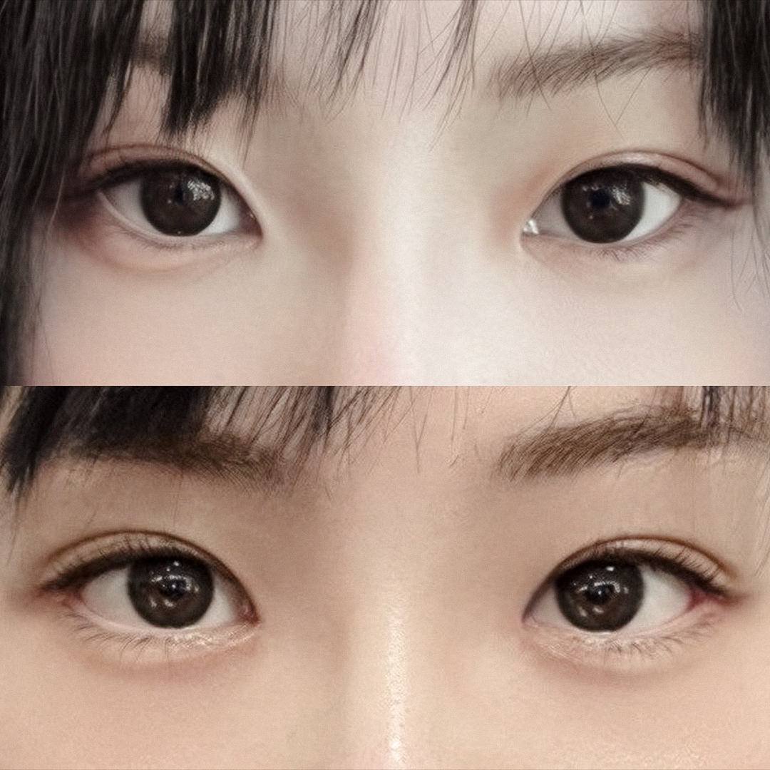 Địa chỉ nổi tiếng mở đuôi mắt hạ mí dưới ✨ 1 tháng sau phẫu thuật tại Thẩm mỹ Hyundai