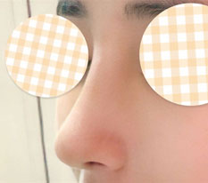 Tôi mừng vì đã loại bỏ chỉ hiko và phẫu thuật mũi