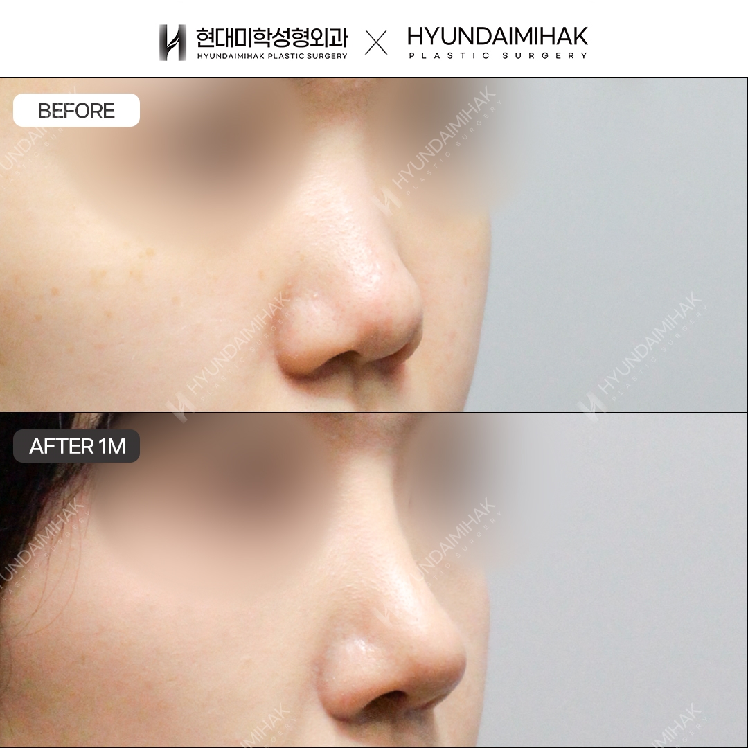 [Tái phẫu thuật mũi] Sống mũi + đầu mũi, sau 1 tháng