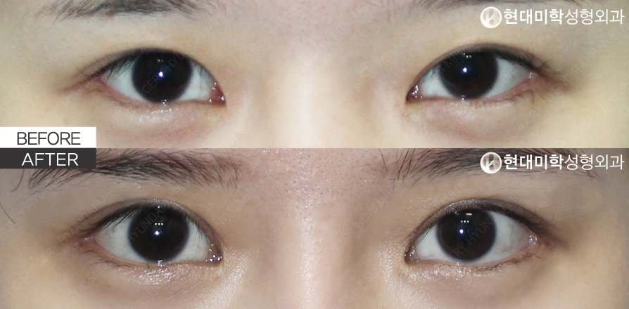 Chỉnh cơ nâng mi bằng đường rạch (phẫu thuật lại)