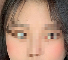 Mình đã làm phẫu thuật lại xương gò má~ Cảm ơn vì làm đẹp cho mình^^