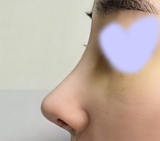 Đã 2 tuần kể từ khi phẫu thuật mũi lần hai~~!