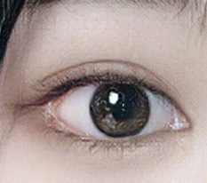 Đã 2 tháng kể từ khi làm dual canthoplasty — làm tốt không??