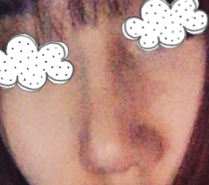 Làm mũi xong thay đổi hình ảnh hoàn toàn '-'♥
