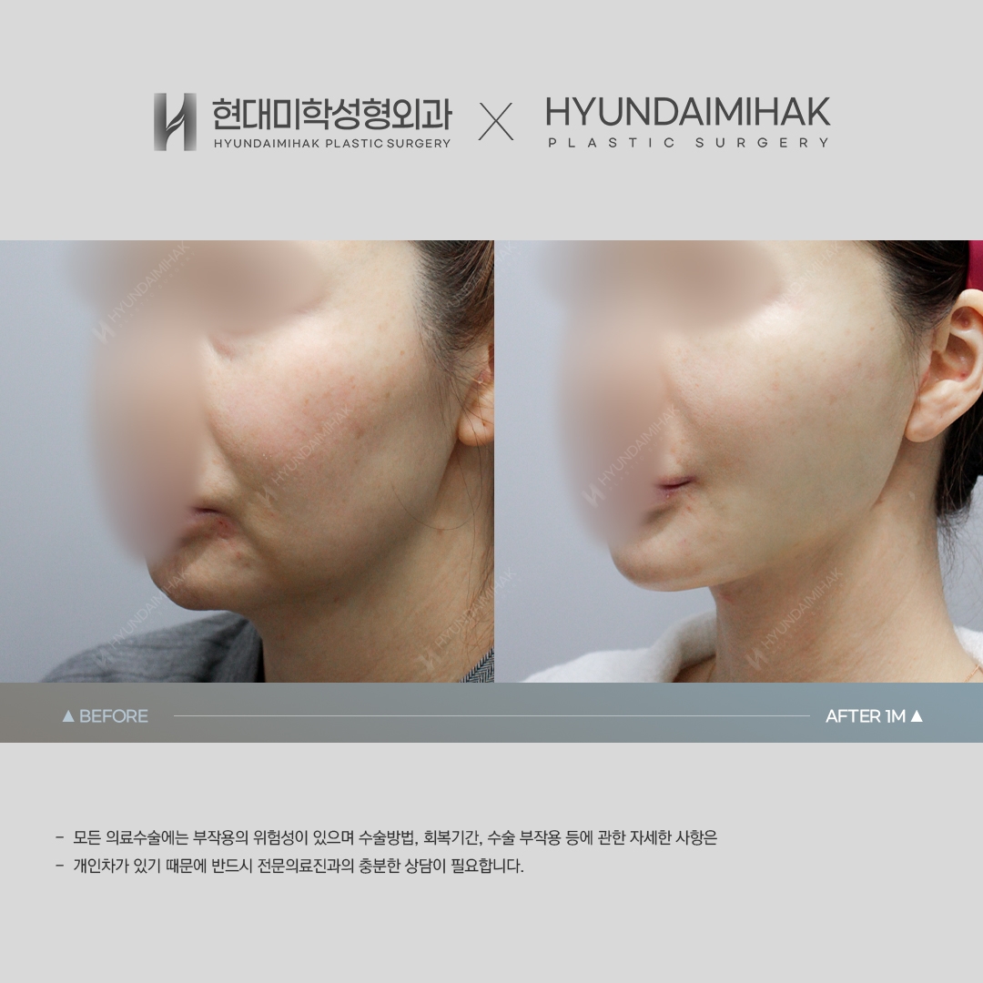 [Phẫu thuật trẻ hóa] Căng chỉ sau 1 tháng