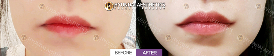 Nâng khóe miệng + Rãnh marionette + Botox khóe miệng