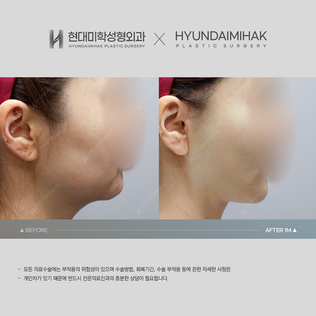 [Phẫu thuật trẻ hóa] Căng chỉ sau 1 tháng