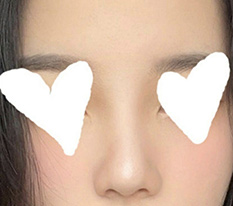 Chỉnh mũi hếch thành công rồi^,^