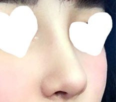 Everyone was shocked when they saw my nose ;;;;