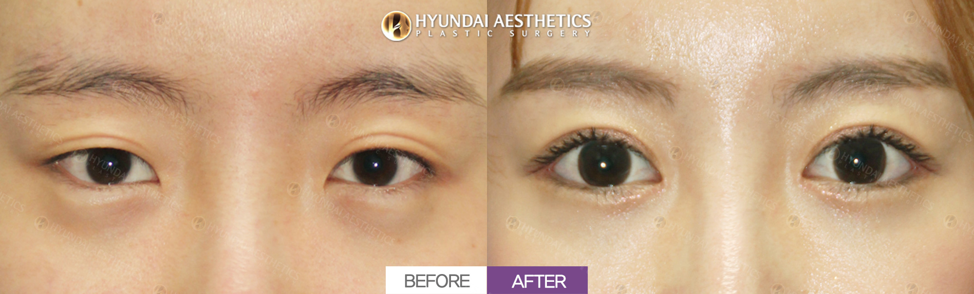 Chỉnh cơ nâng mi đường rạch + tạo mắt hai mí + mở góc mắt trong + mở góc mắt ngoài + hạ mí dưới, sau 1 tháng