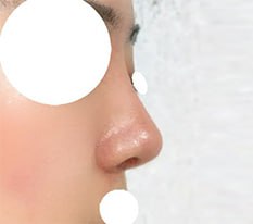 Hoàn thiện chiếc mũi thanh tú!!!