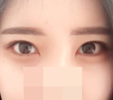 Nhờ có phẫu thuật mở đôi khóe mắt