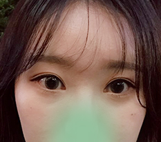 Thay đổi hình ảnh thành công nhờ chỉnh cơ nâng mi và mở góc mắt :)