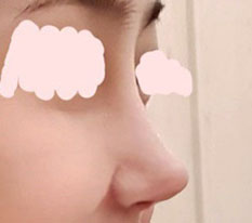 Thay đổi sau phẫu thuật sửa mũi