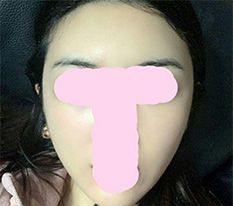 Đã một tháng kể từ khi phẫu thuật gò má ^^