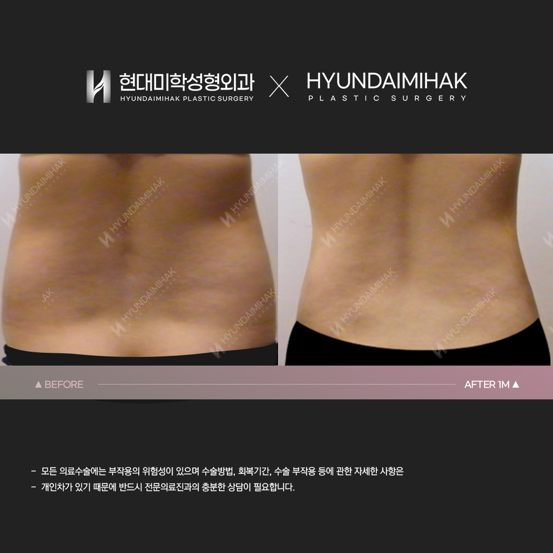 Hút mỡ bụng sau 1 tháng