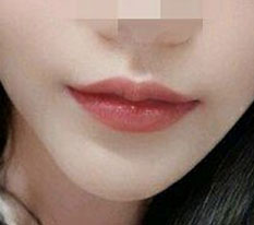 Review được mong chờ nhất — 6 tháng sau nâng khóe miệng ㅜㅜㅜㅜㅜㅜ