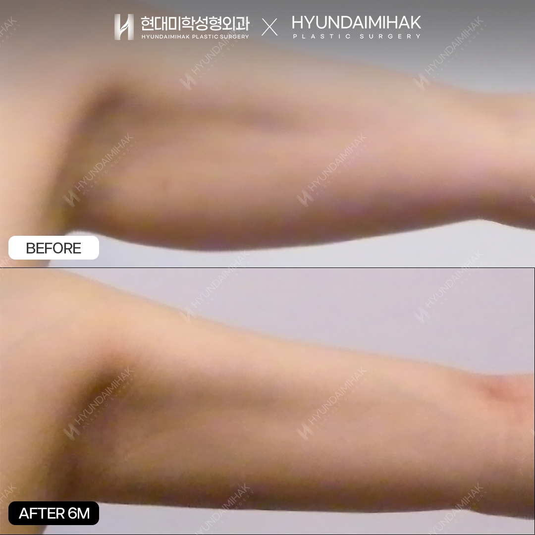 Hút mỡ bắp tay sau 6 tháng