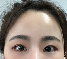 Nâng trán được 3 tháng rồi