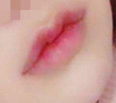 I highly recommend Thẩm mỹ Hyundai mouth-corner + Cupid lip surgery