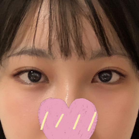Review mở góc mắt và tái phẫu thuật mí đôi cho mắt nhỏ hẹp