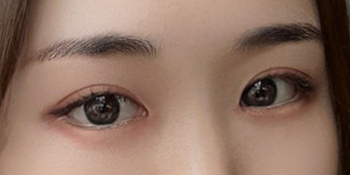 #Tái phẫu thuật mắt #Tái phẫu thuật mí đôi rạch da #Mở góc mắt kép #Chỉnh cơ nâng mi