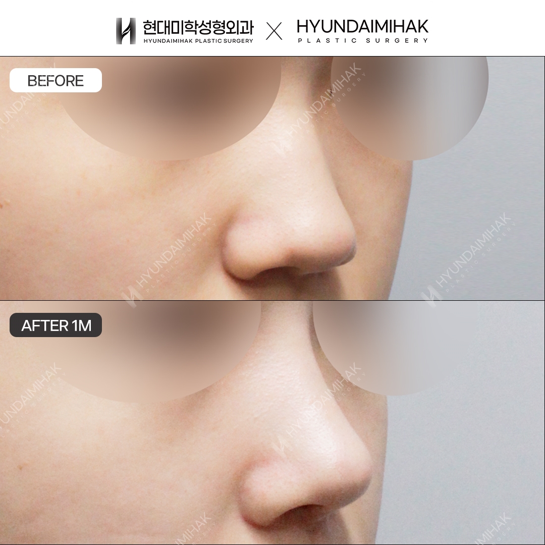 [Chỉnh mũi thấp] Sống mũi + đầu mũi, sau 1 tháng