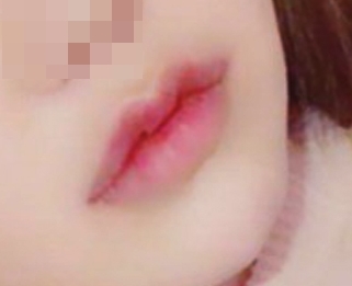 Phẫu thuật môi thật thần kỳ~~