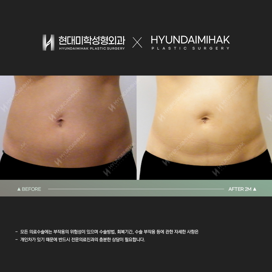 Hút mỡ bụng sau 2 tháng