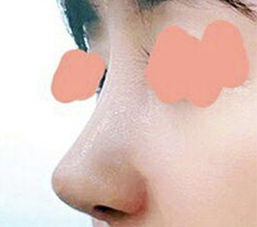 Tôi thử đăng review sửa mũi haha