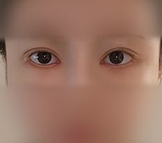 Gỡ filler bọng cười rất gọn