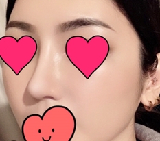Mình để lại review phẫu thuật lại~*_*