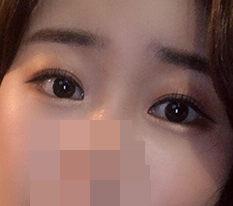 Tôi nghĩ có mí đôi mà không làm mắt thì thật sự thiệt thòi haha (review dual canthoplasty + mở góc mắt trong)