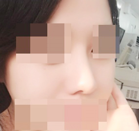 Phẫu thuật mũi tuyệt vời nhất — hài lòng tột đỉnh ♥!!