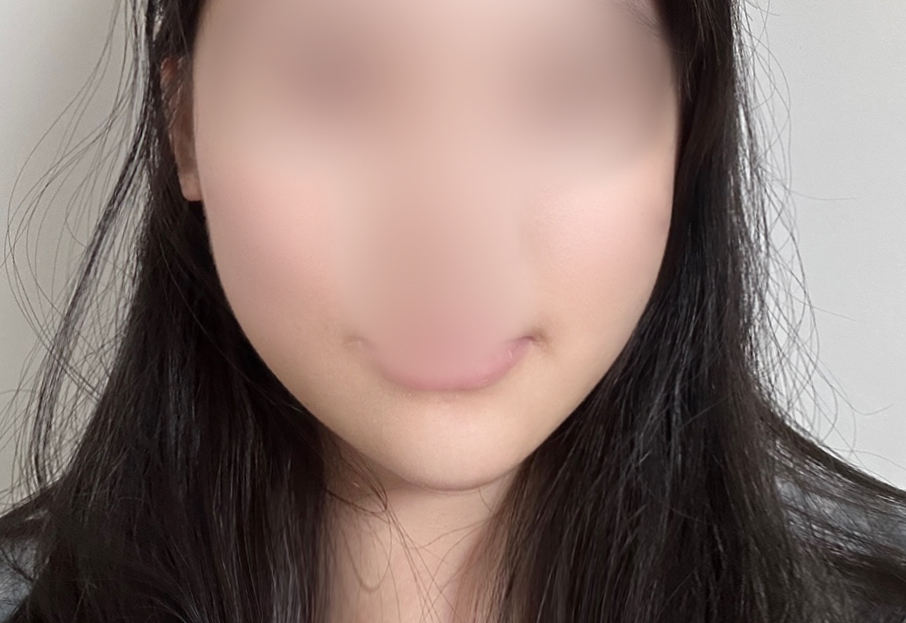 Tôi chỉnh bất đối xứng khuôn mặt bằng căng chỉ