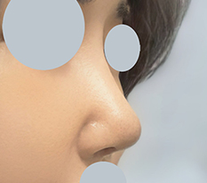 Donated rib rhinoplasty, good