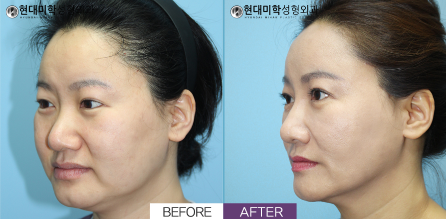 Elastikoom, căng chỉ, hút mỡ, laser Venus