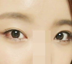 Tôi đã làm Perfect Big Eye + Canthoplasty kép
