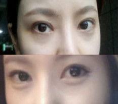 Giờ tôi cũng đang sống với đôi mắt rõ nét rồi đó, kya