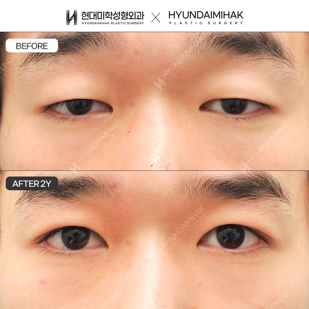 [Phẫu thuật mắt nam] Chỉnh cơ nâng mi không rạch