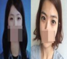 Cắt mí + mở góc mắt trong^^