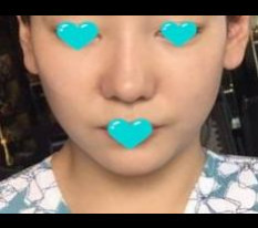 Mình vui vì mũi đã đẹp hơn!
