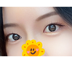 Mở góc mắt kép không có tác dụng phụ