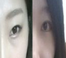 Mở khóe kép kèm nhấn mí! Biến thành đôi mắt xinh rồi~^0^