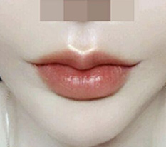 Đã 3 tháng kể từ khi phẫu thuật khóe miệng ㅎㅎㅎ