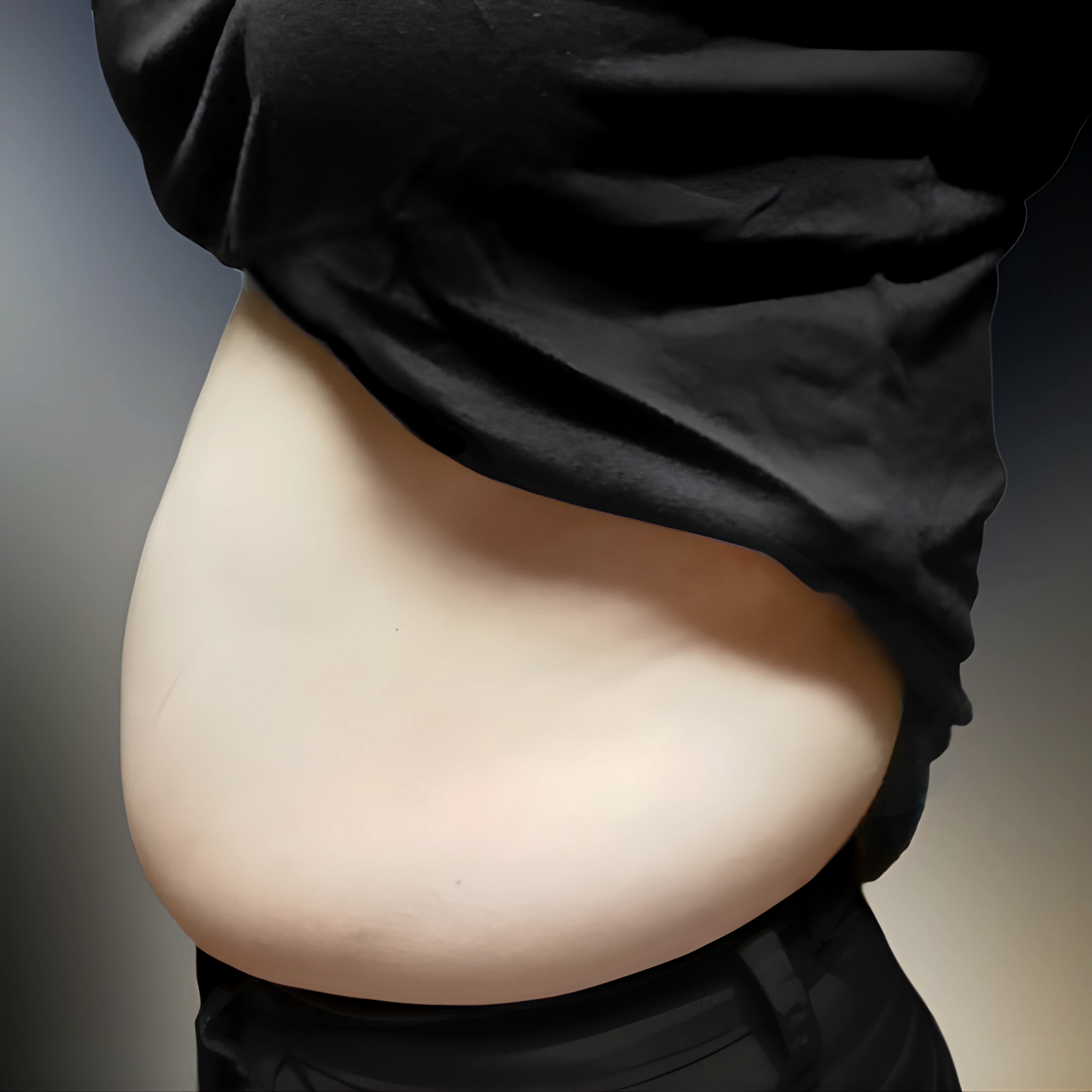 Tôi đã cắt bớt mỡ bụng #lovehandles #hông #hôngsau #bụng