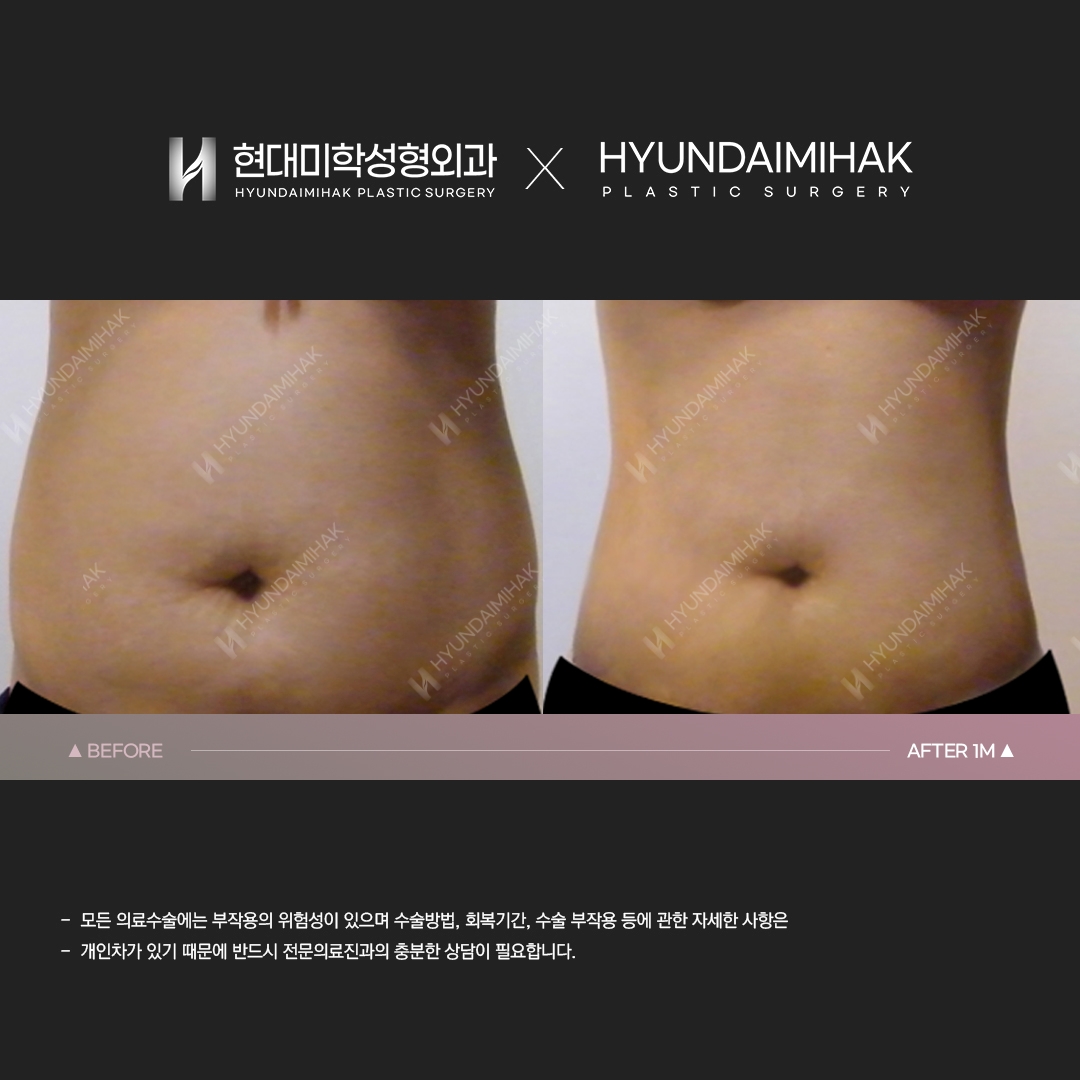 Hút mỡ bụng sau 1 tháng